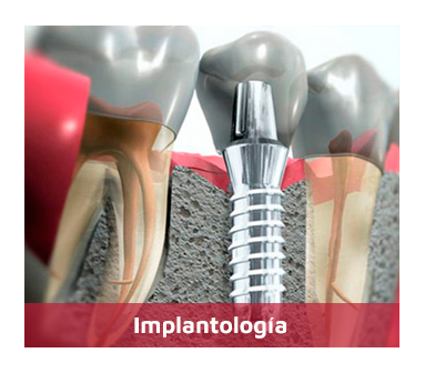 Implantologia-1