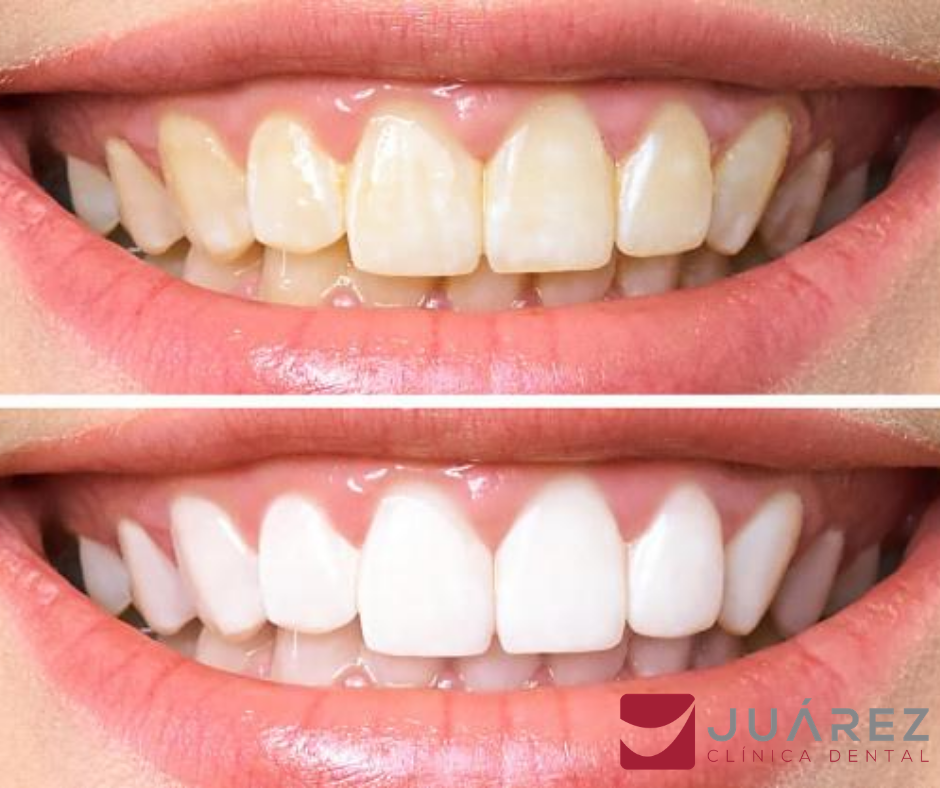 Trastornado he equivocado Avispón Una sonrisa bonita y unos dientes más blancos gracias al blanqueamiento  dental – Juárez Clínica Dental